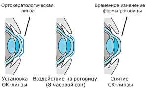 Ночные линзы для восстановления зрения для детей – отзывы и рекомендации