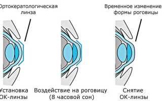 Ночные линзы для восстановления зрения для детей – отзывы и рекомендации