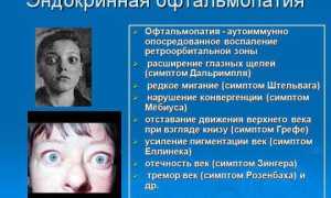 Как справиться с эндокринной офтальмопатией? Полезные советы и рекомендации