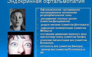 Как справиться с эндокринной офтальмопатией? Полезные советы и рекомендации
