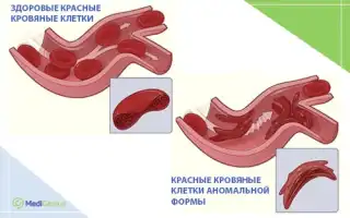 Серповидная анемия — предотвращение приступов, лечение