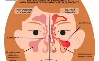 Гайморит при беременности: чем лечить и как предотвратить