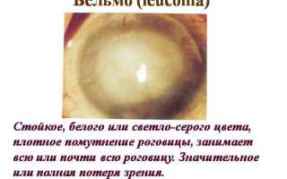 Помутнение роговицы глаза – ключевые особенности, опасности и подходы к терапии для здоровья