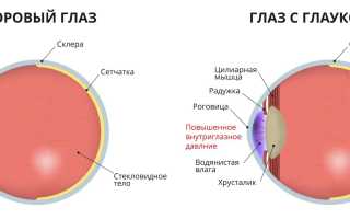 Причины возникновения глаукомы и их последствия