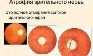 Можно ли устранить частичную атрофию нерва глаза? Узнайте мнение специалистов