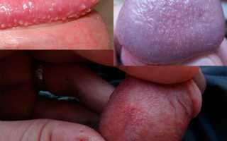 Кандидоз у мужчин на ногтях