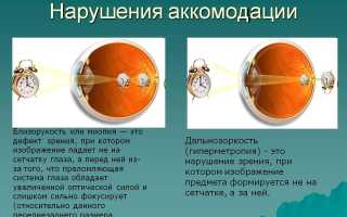 Зрение не фокусируется – причины, если расфокусировался взгляд, фокус глаз и рекомендации