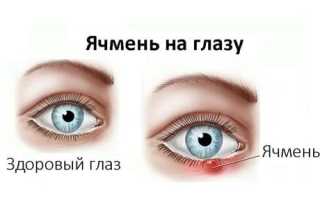 Причины появления ячменя на глазу у взрослого – болезнь и ее последствия
