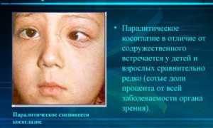 Паралитическое косоглазие: причины и лечение
