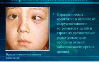 Паралитическое косоглазие: причины и лечение