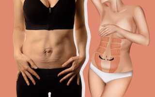 Лечение диастаза у беременных: методы и последующая профилактика для здоровья