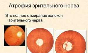 Атрофия зрительного нерва: где можно вылечить и восстановить зрение?