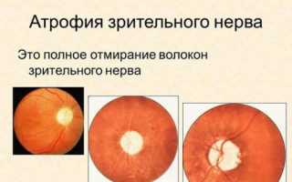 Атрофия зрительного нерва: где можно вылечить и восстановить зрение?