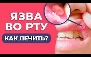Язвочки на языке и во рту: симптомы и лечение, видео: как быстро избавиться