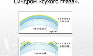 Что такое синдром сухого глаза? Узнайте причины и симптомы.