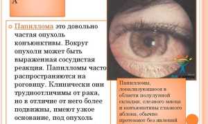Как избавиться от папилломы на веке: советы и рекомендации