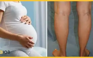 Варикоз при беременности: что делать для здоровья