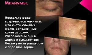 Эффективные методы удаления милиумов на коже