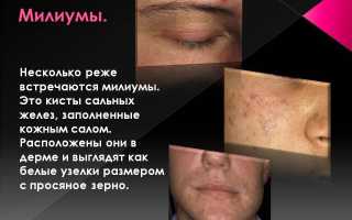 Эффективные методы удаления милиумов на коже
