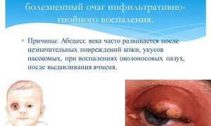 Абсцесс века: причины возникновения и методы устранения, советы специалистов