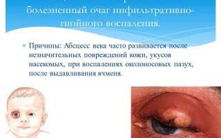 Абсцесс века: причины возникновения и методы устранения, советы специалистов