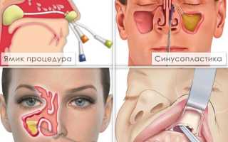 Лечение гайморита, симптомы, профилактика, эффективные рецепты