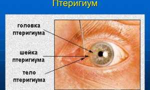 Птеригий глаз – что это птеригиума, пленка у человека и его лечение