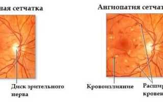 Лечение ангиопатии сетчатки глаза у ребенка: советы и рекомендации