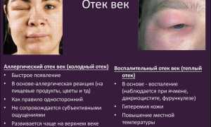 Отекают верхние веки: почему это происходит и что делать для улучшения состояния
