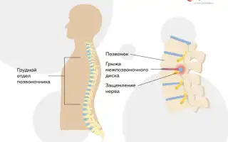 Грудной радикулит: причины, виды, способы лечения и снятия болей, видео