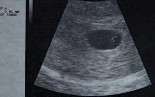 Анэмбриония на ранних сроках беременности: причины и последствия