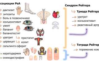Реактивный артрит: заражение, симптомы, способы лечения, видео