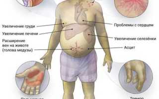 Алкогольный цирроз печени: что такое и как можно вылечить? Восстановление