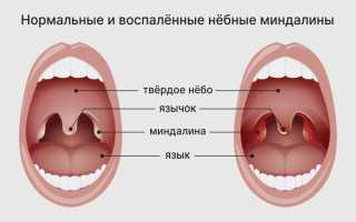 Ангина при беременности: симптомы и лечение