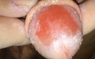 Как выглядит молочница у мужчин на фотографиях и как лечить