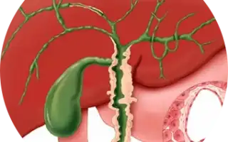 Воспаления желчных путей и симтомы: катаральная желтуха, холангиты, видео