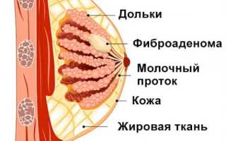 Фиброаденома и беременность: причины возникновения, как влияет на плод, прогнозы и рекомендации
