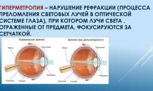 Гиперметропия: степени – слабая и скрытая глаз, что это такое и как с этим жить