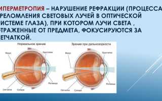 Гиперметропия: степени – слабая и скрытая глаз, что это такое и как с этим жить