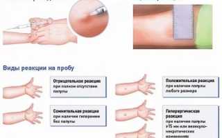 У ребенка плохая прививка на туберкулез