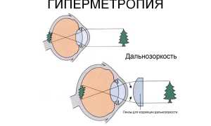 Дальнозоркость у годовалых детей – норма или патология? Важные аспекты