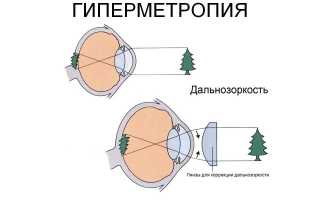 Дальнозоркость у годовалых детей – норма или патология? Важные аспекты