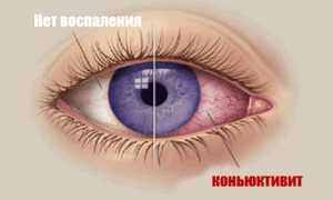 Мазь для глаз от конъюнктивита – ключевые разновидности и их особенности
