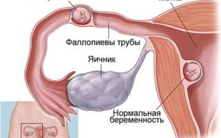 Чем опасна внематочная шеечная беременность для здоровья женщин