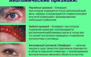Блефарит – симптомы и лечение воспаления века у взрослых