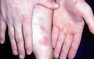 Лечим реовирусную инфекцию