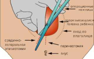 Эпизиотомия при родах: что это, зачем проводят, как ее избежать и последствия