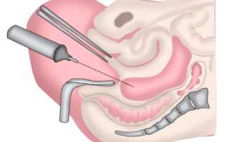 Кульдоцентез при внематочной беременности: важные аспекты и показания