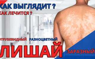 Отрубевидный лишай: эффективное лечение- народные средства, видео