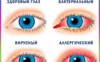 Конъюнктивит у детей: особенности заболевания и степень его заразности, профилактика и лечение